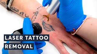 Fast Facts How Long Does Laser Tattoo Removal Really Take [upl. by Humph]