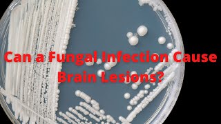 Can A Fungal Infection Cause Brain Lesions [upl. by Aysab211]