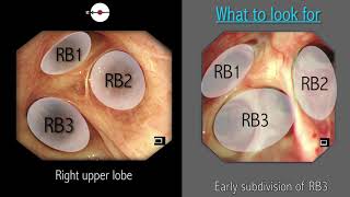 Mastering Bronchoscopy for Thoracic Surgery Chapter 2 [upl. by Nolrev212]