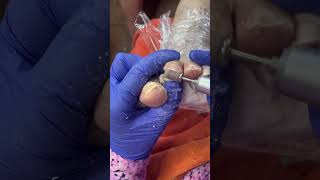 Callus removal at Patients home pedicureathome callusremoval selfcare [upl. by Acired753]