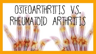 Osteoarthritis vs Rheumatoid Arthritis [upl. by Svensen]