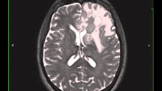 Grade 3 Anaplastic Astrocytoma [upl. by Lyndon]