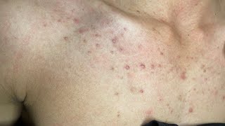 ACNE TREATMENT VU QUYNH MI  Acne Chest Of Boy 2024 [upl. by Rukna]