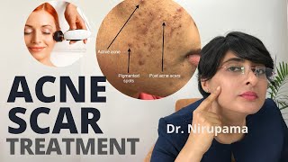 Acne scar removal video Acne scar cream Acne scar laser Acne scar doctor Acne scars kaise hataye [upl. by Disario]