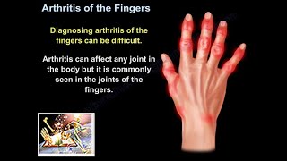 Arthritis Of The Fingers  Everything You Need To Know  Dr Nabil Ebraheim [upl. by Yregerg]