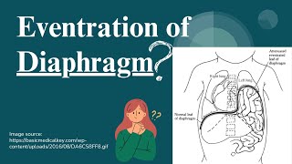 What is Eventration of Diaphragm [upl. by Llieno]