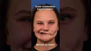 A smile can change someone’s life 😊 facialparalysis facialnerve smilereanimation drazizzadeh [upl. by Pegasus]