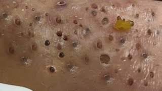 blackheads new this week  popping pimple asmr  blackheads and whiteheads removal [upl. by Adnovoj]