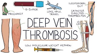 Understanding Deep Vein Thrombosis DVT [upl. by Etteloc370]