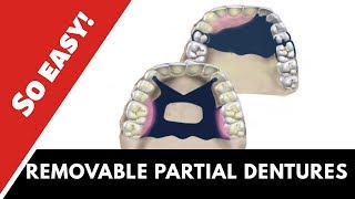 Partial dentures  ɪɴᴅɪᴄᴀᴛɪᴏɴꜱ amp ᴄᴏɴᴛʀᴀɪɴᴅɪᴄᴀᴛɪᴏɴꜱ [upl. by Anale]