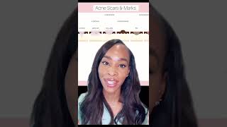 HOW TO REDUCE ACNE SCARS [upl. by Reifnnej]