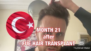 MONTH 21 after FUE Hair Transplant in Turkey  3500 grafts  Norwood 3 Vertex  Crown 🇹🇷 [upl. by Nostets999]