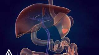 Whipple Procedure  3D Medical Animation [upl. by Socrates548]