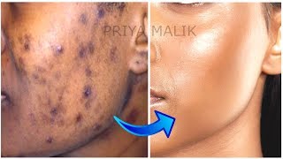 Use Just 1 Ingredient To Remove Dark Spots Pimple Marks Pigmentation Permanently Priya Malik [upl. by Cindy]