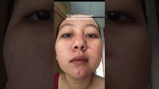 Review Wardah Acnederm Part1 [upl. by Arramahs431]