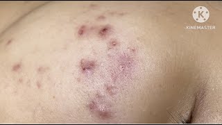 Inflammatory acne on cheeks HoangMySpa63 [upl. by Auhsuj]