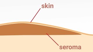 Seromul si indepartarea lui  Removal of postoperative Seromas [upl. by Annayehc]