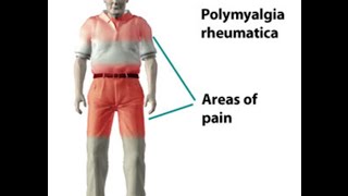 Polymyalgia Rheumatica [upl. by Thrasher]