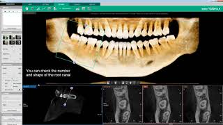 Clinical Case  Ez3Di  Endodontic Treatment C shaped Root Canal Case [upl. by Roswald]