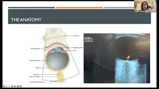 Neurocritical Care amp Pearls Noninvasive Monitoring of Intracranial Pressure Alexandra Reynolds MD [upl. by Loris]