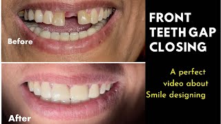 Front teeth gaping treatment with Zirconia Crowns  solution for space between front teeth [upl. by Magdalen412]