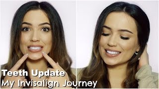 Invisalign Update Journey  More Refinements [upl. by Tahpos984]