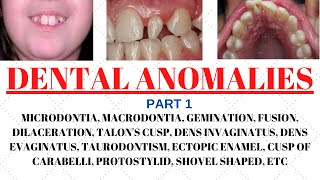 Developmental disturbances in teeth  Dental anomalies  Odontology notes  UGC NET Forensic science [upl. by Rahal]