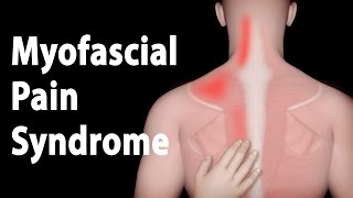 Myofascial Pain Syndrome and Trigger Points Treatments Animation [upl. by Nyleimaj]