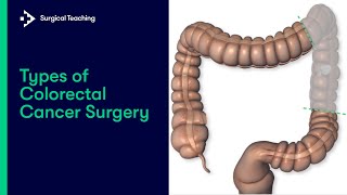 Types of Colorectal Cancer Surgery  What are the Different Operations We Can Perform [upl. by Aicilec]