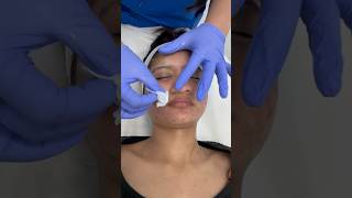 Second chemical peel session done acnetreatment chemicalpeel mandalicpeel chemicalpeeltreatment [upl. by Jens809]