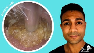 1485  Masses of Dead Skin Removed from Both Ears  Learn About Different Ear Wax Drops [upl. by Eseerehs]