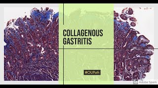 Collagenous gastritis [upl. by Salta450]