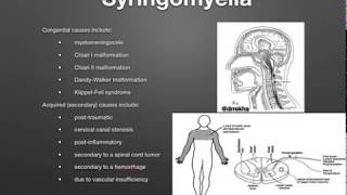 SyringomyeliaCSF Dynamics [upl. by Ajile]