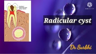 Radicular cystmost prevalent odontogenic cyst [upl. by Eilrebma305]