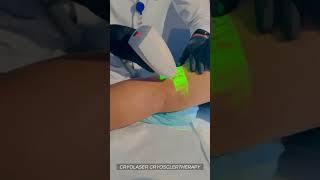 Tratamiento de Arañitas Vasculares con CLACS  CRYOLASER AND CRYO SCLERTHERAPY [upl. by Jareen]