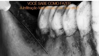 Você Sabe Como Fazer a Infiltracao Mandibular com Articaina [upl. by Carney]