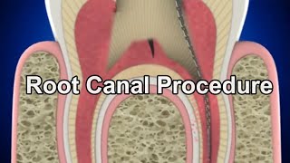 Root Canal Procedure [upl. by Dietz]