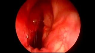 Tuberculose laryngée par endoscopie [upl. by Belva]