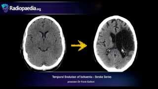 Stroke Evolution from acute to chronic infarction  radiology video tutorial CT MRI [upl. by Raviv299]