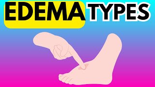 DIFFERENT TYPES OF EDEMA  TRANSUDATE VS EXUDATE [upl. by Brandyn624]