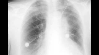 Left Upper Lobe Atelectasis on Chest X ray [upl. by Strauss]