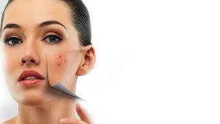 How To Treat Acne Scars  Expert Advice  Post Acne Skin Care  Glamrs [upl. by Sobmalarah]