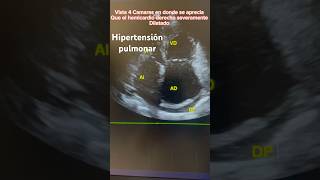 Hipertensión Pulmonar Ekg y electrocardiograma [upl. by Dnalyar]