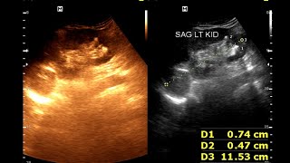 Hydro nephrosis  Renal cortical cyst  Renal calculus [upl. by Noirrad]