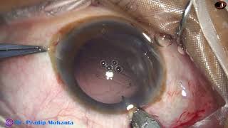 Management of Posterior capsular rent with intact anterior hyaloid Membrane  P Mohanta Oct  2023 [upl. by Freddie]