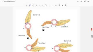 Annular Pancreas [upl. by Arissa214]