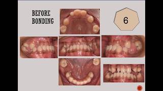 Different Types of Malocclusion  Treatment at BPKIHS Dharan Department of Orthodontics [upl. by Rednael]