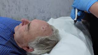 Cryotherapy for Actinic Keratosis on Face [upl. by Derril]