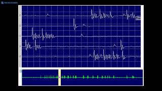 Kimura amp Kohara F34 Typical myokymic discharge seen in a demyelinating neuropathy [upl. by Rebeh914]