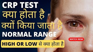 CRP test kya hota hai  crp test in hindi  crp test normal range  crp high hone se kya hota hai [upl. by Ahtamat]